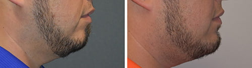 Before and After Chin Augmentation