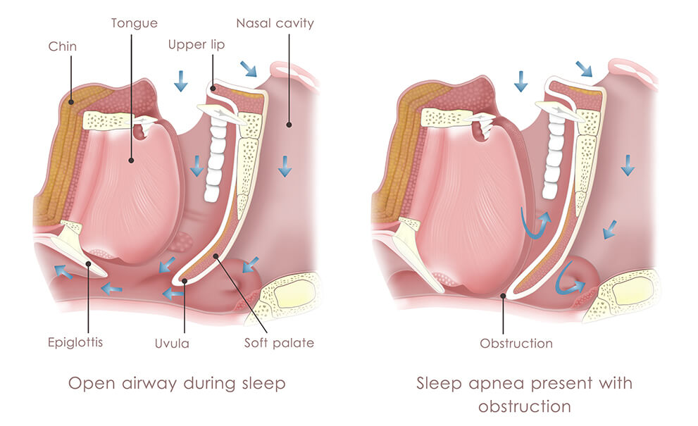 Medical Illustration of Obstructive Sleep Apnea