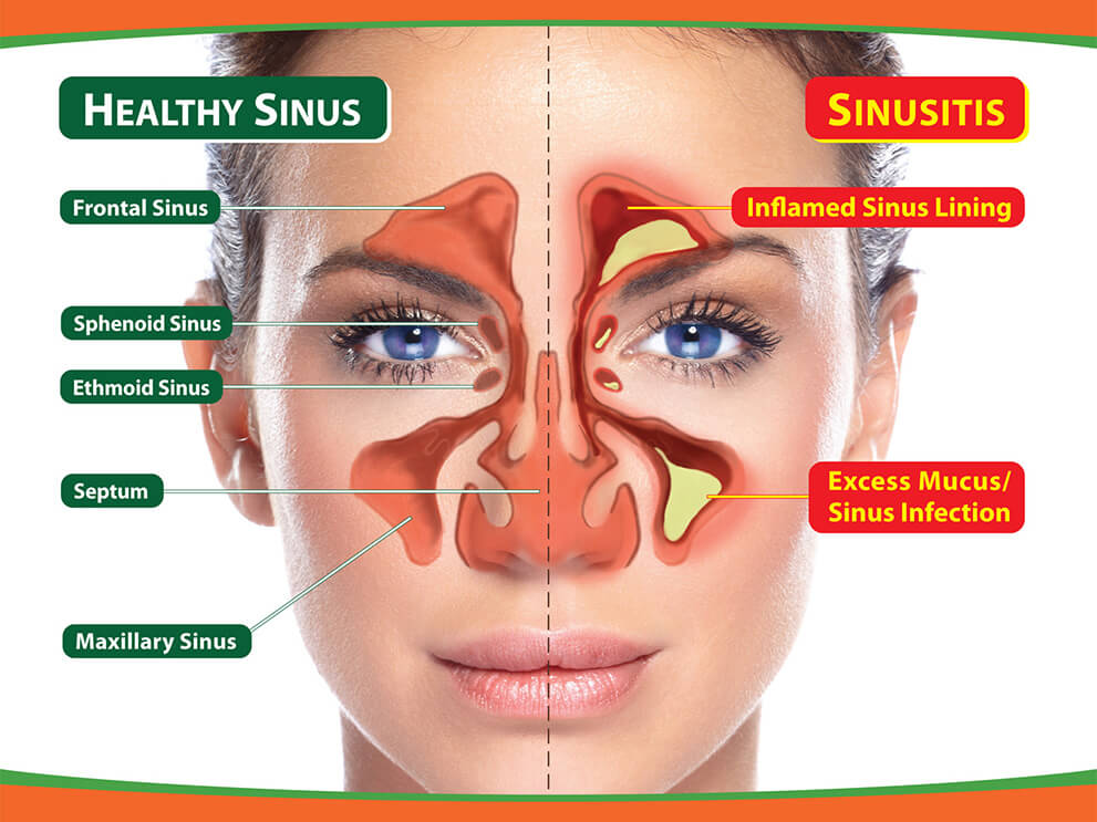 Healthy Sinus vs Sinusitis Diagram