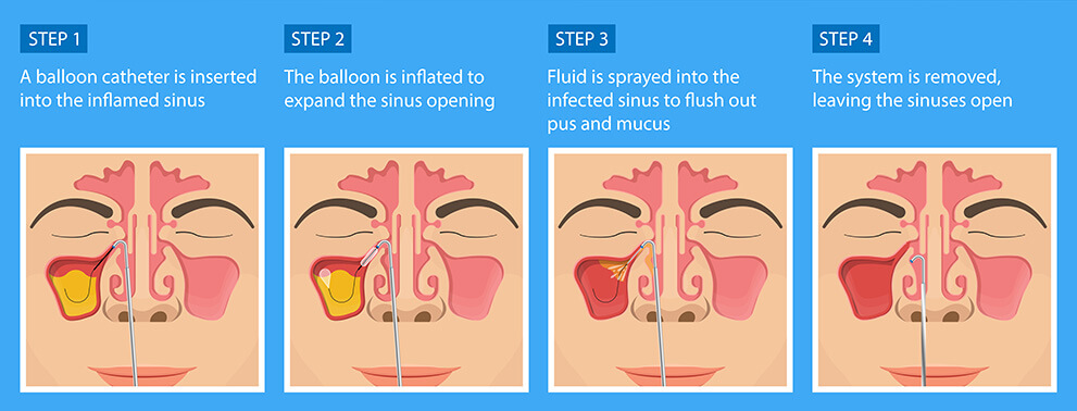 baby sinus infection smell