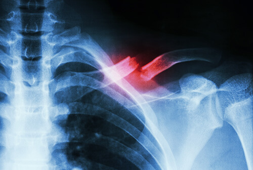 X-ray of broken clavicle