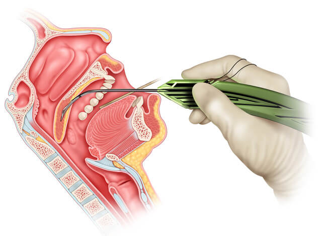 Medical Illustration of Elevoplasty Procedure for Snoring