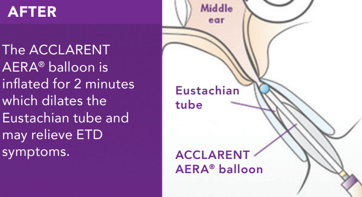 Eustachian Tube Dysfunction Remedies