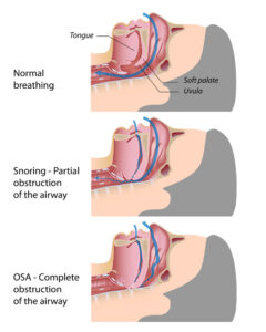 A sleep apnea diagram.