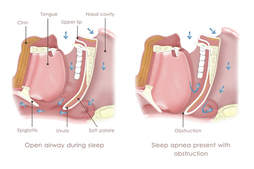 diagram of sleep apnea