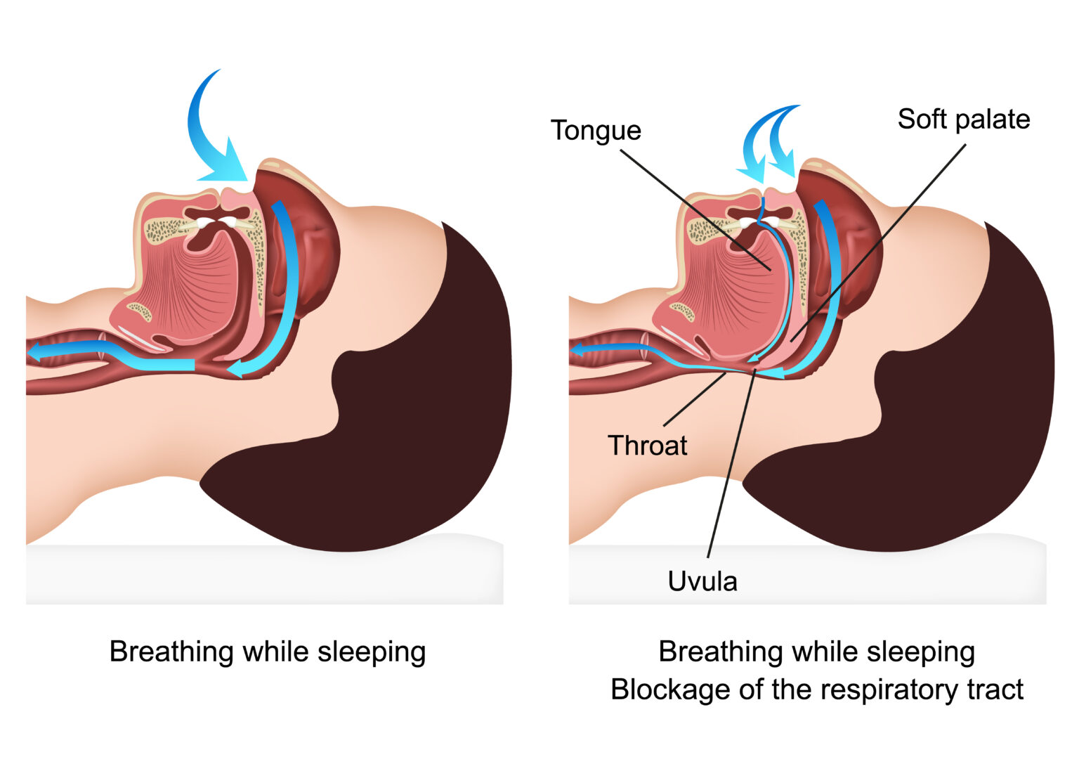 is-my-snoring-really-a-problem-snoring-chicago-chicago-ent-2021