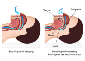 A diagram of overly relaxed muscles while sleeping