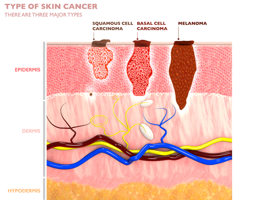 Three major types of skin cancer affecting layers of the skin.