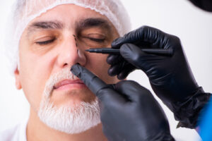 rhinoplasty surgery