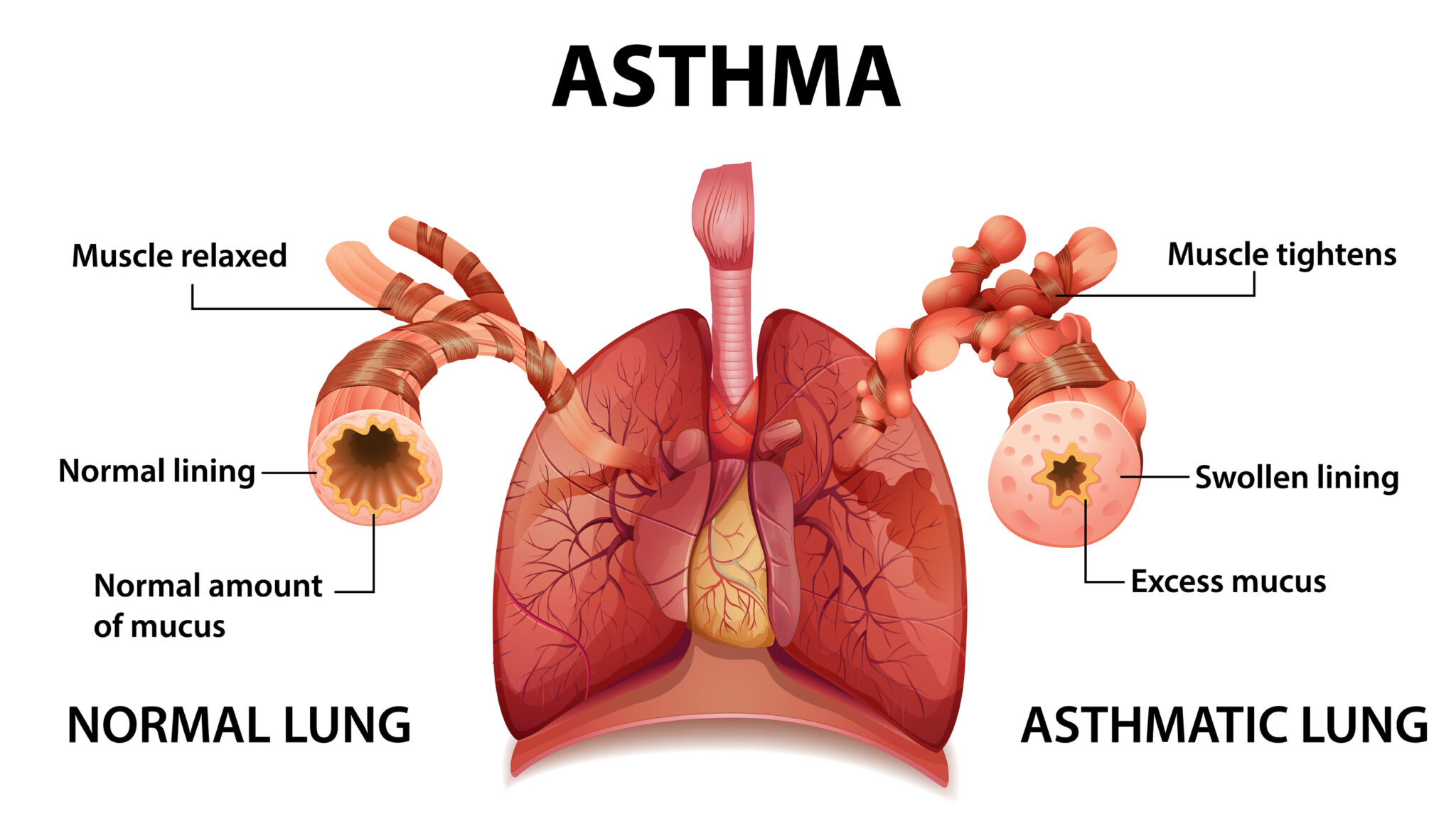 What are the Signs of an Asthma Attack? - Chicago ENT