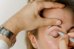 blepharoplasty surgery