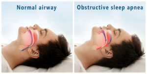 Speel Apnea  Front Range Otolaryngology